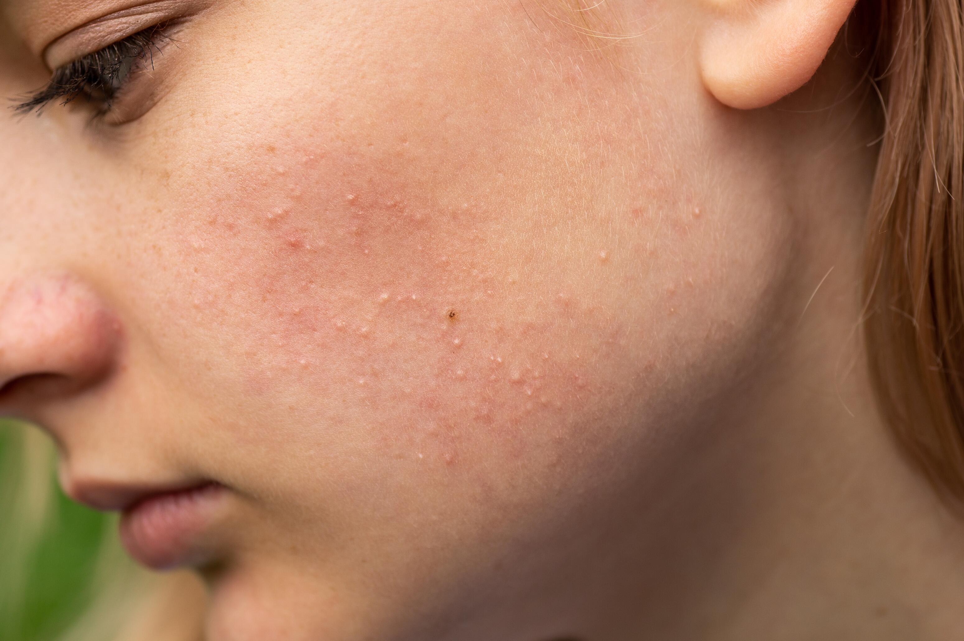 Retentional acne with closed comedones